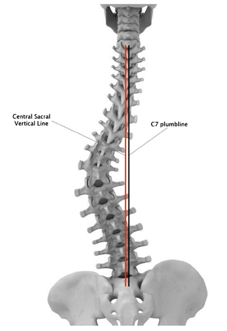 Spinal balance 