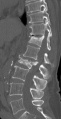 Osteoporose fraktur L2.jpg
