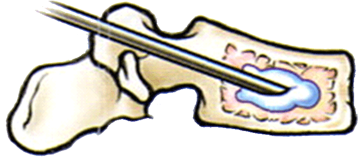 Vertebroplastik