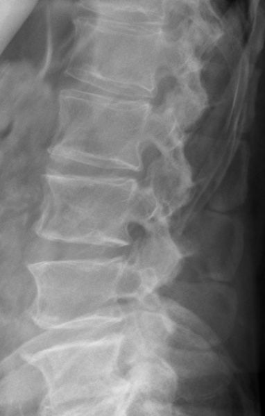 Fil:Kissing spine.jpg