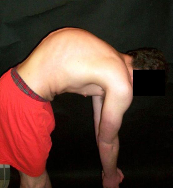 Fil:Scheuermanns diseasebl.jpg
