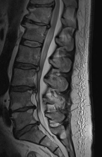 Fil:Lipomatose2.jpg