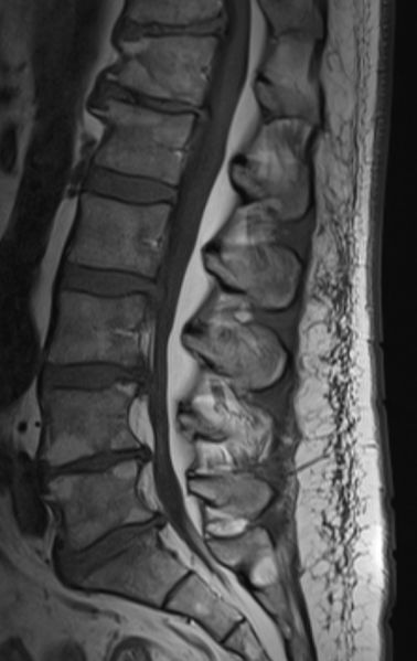 Fil:Lipomatose1.jpg