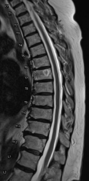 Fil:Osteoidt osteom.jpg