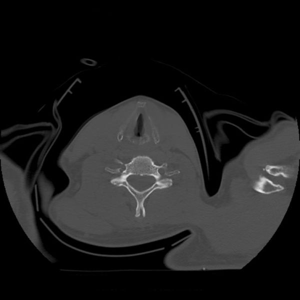 Fil:Foramen.jpg